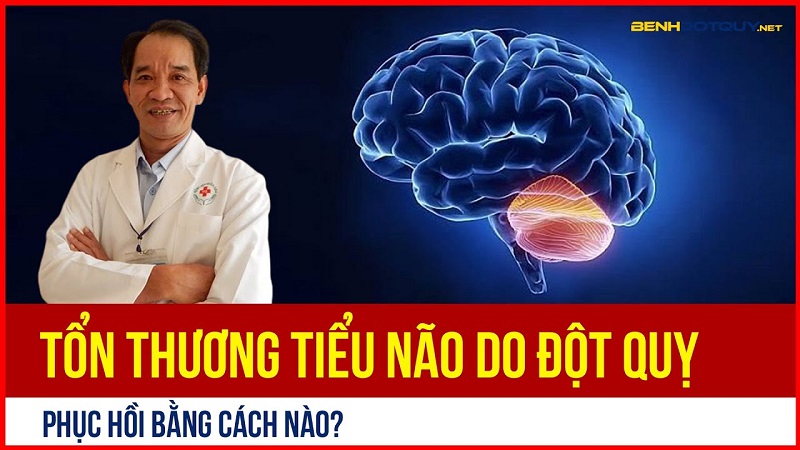 Tổn thương tiểu não do đột quỵ, phục hồi bằng cách nào?