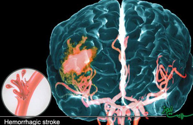 Người bị mạch máu thoái hoá dạng bột, nguy cơ đột quỵ thế nào?