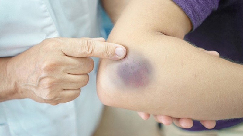 Rối loạn đông máu trong thai kỳ là gì và làm sao nhận biết?