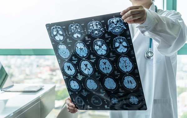 Đối tượng nào cần tầm soát đột quỵ sớm?