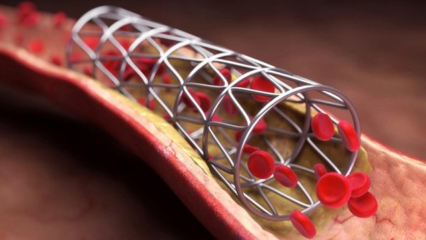 Nhồi máu cơ tim, đã đặt stent có thể phục hồi không?