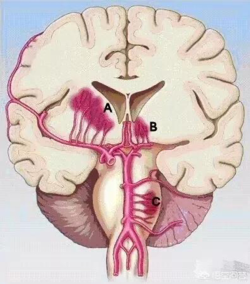 Nhồi máu não lỗ khuyết: Nguyên nhân và cách phòng ngừa?