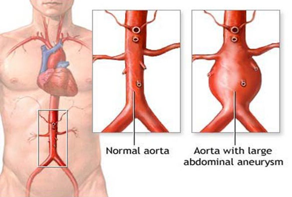 Phình động mạch chủ bụng nguy hiểm thế nào?