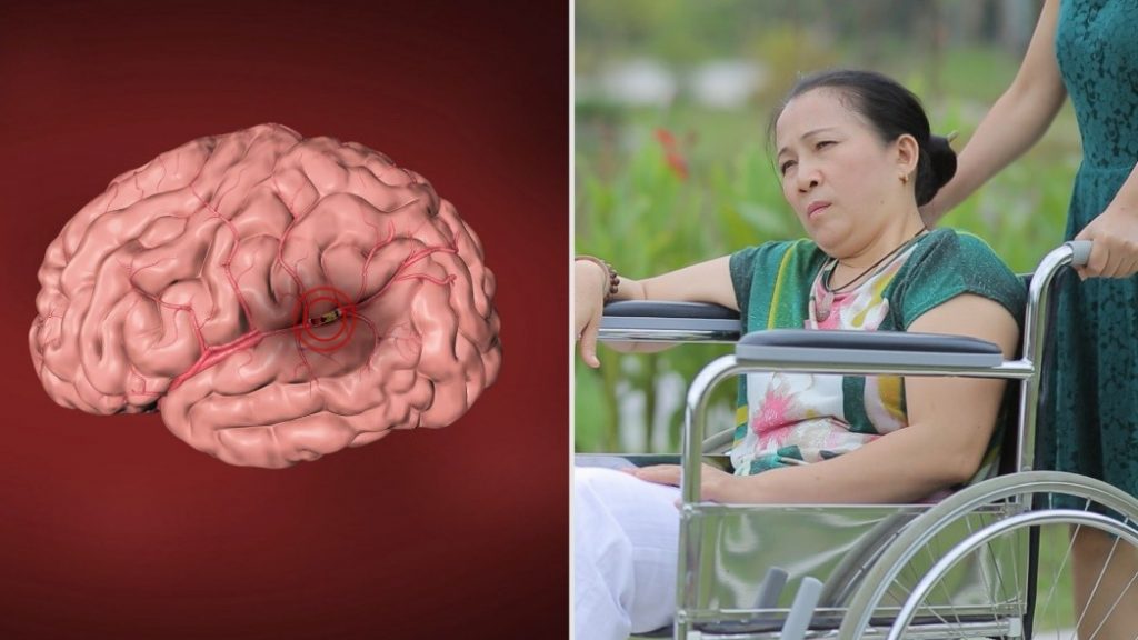 Đột quỵ có thể gây tê liệt không?