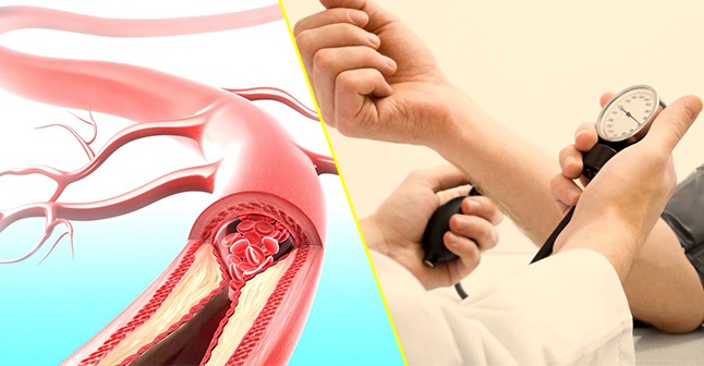 Nguyên nhân gây xơ vữa động mạch?