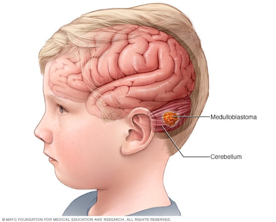 Khối u não ở trẻ em