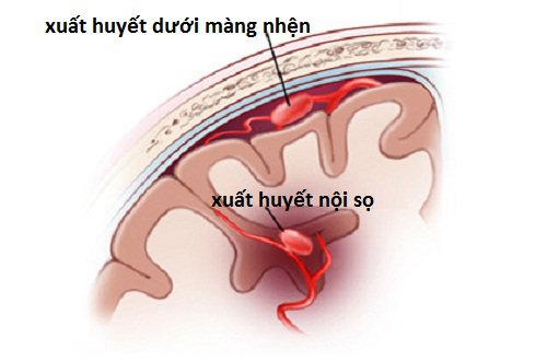 Xuất huyết dưới nhện là trường hợp máu chảy giữa não và các mô mỏng bao phủ não (màng não)