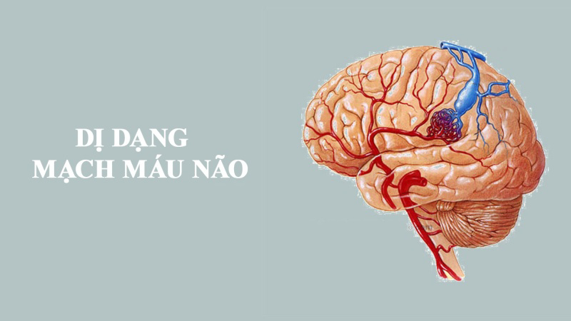 Nguyên nhân gây dị dạng mạch máu não?