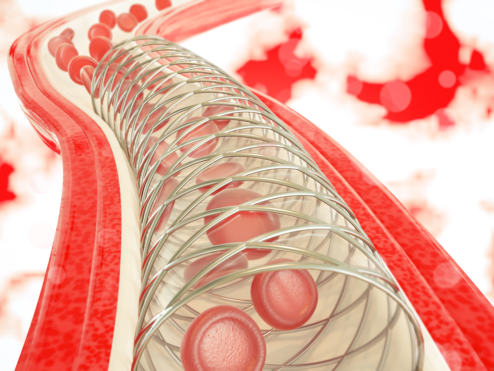 Đặt stent có gây biến chứng không?