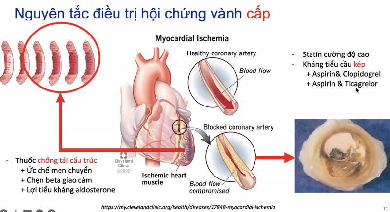 Nguyên tắc điều trị hội chứng vành cấp