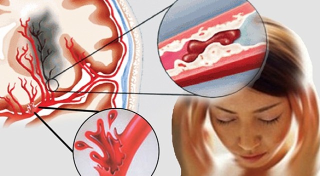 Có thể cảm nhận cơn đột quỵ trước 1 tuần không?