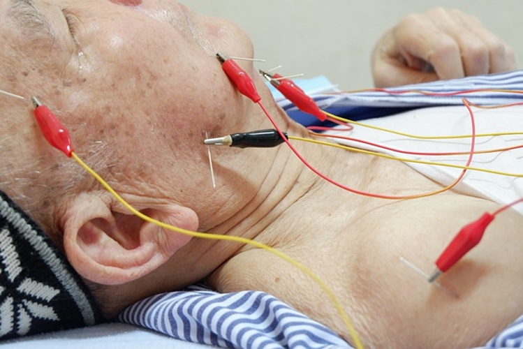 Châm cứu thúc đẩy sự tăng sinh tế bào trong hệ thần kinh trung ương sau tai biến.