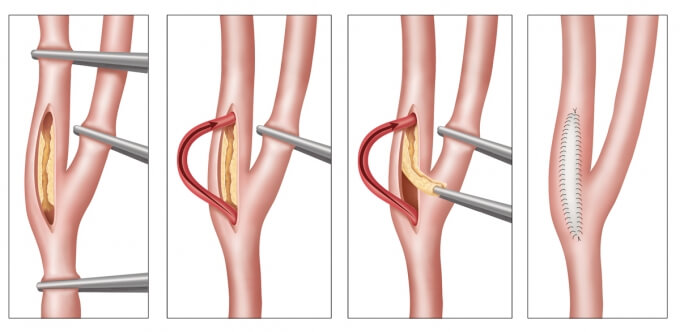 Phẫu thuật bóc nội mạc động mạch cảnh có vai trò ngăn ngừa các nguy cơ dẫn đến đột quỵ.