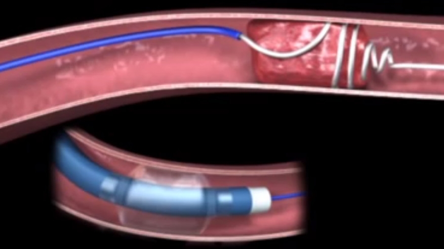 Các loại phẫu thuật để điều trị các dạng đột quỵ khác nhau