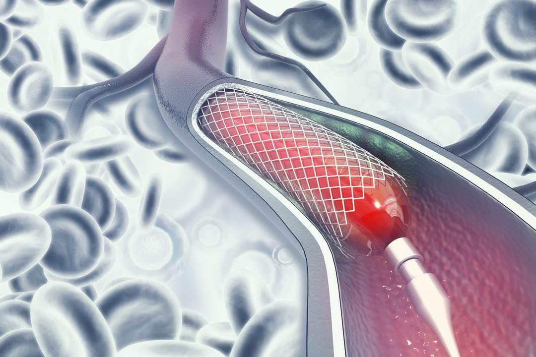 Bệnh mạch vành khi nào điều trị nội khoa, nong và đặt stent?