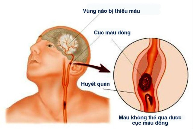 Thuyên tắc mạch: Triệu chứng, chẩn đoán và cách điều trị