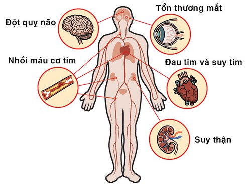 Tăng huyết áp gây ra biến chứng gì?