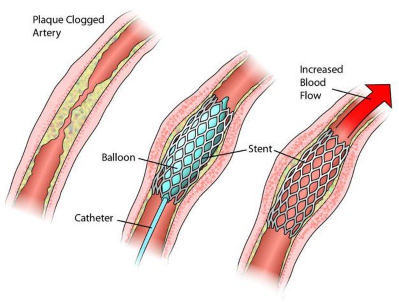 Nong mạch và đặt stent giúp hạn chế sự tắc nghẽn trong động mạch