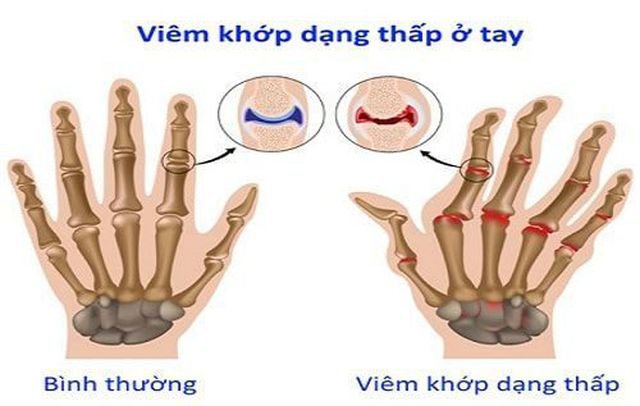 Viêm khớp dạng thấp (RA) là một bệnh tự miễn hệ thống mạn tính.