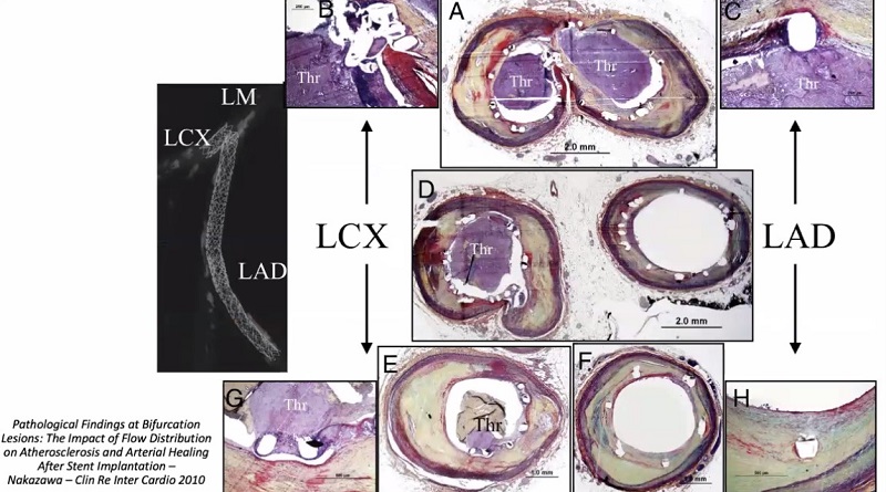 Hình ảnh về trường hợp bệnh nhân 55 tuổi, tử vong sau đặt stent 2 năm, nguyên nhân do không uống thuốc kháng tiểu cầu.