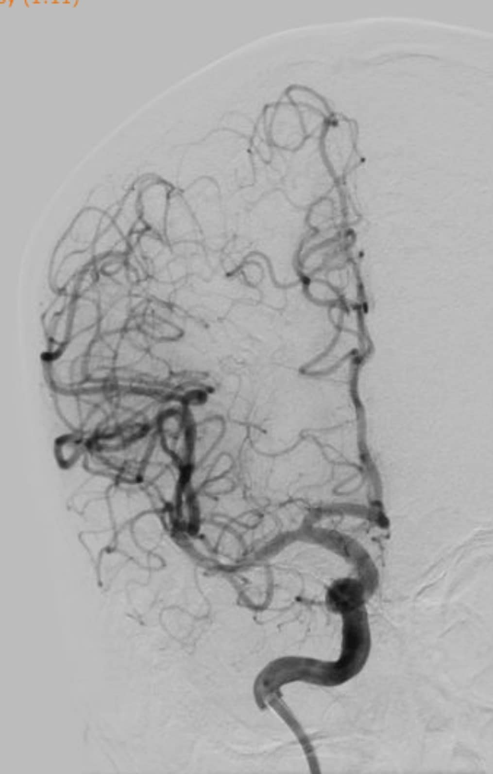 Kết quả CT scan và CTA tại thời điểm giờ thứ nhất, cho thấy bệnh nhân bị tắc hoàn toàn phần xa đoạn M1, đầu M2 động mạch não giữa bên phải. (Ảnh: BVCC)