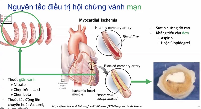 Nguyên tắc điều trị hội chứng vành mạn