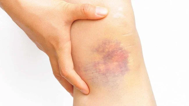 Các dấu hiệu và triệu chứng của chảy máu tự phát bao gồm nhiều vết bầm tím lớn hoặc sâu.