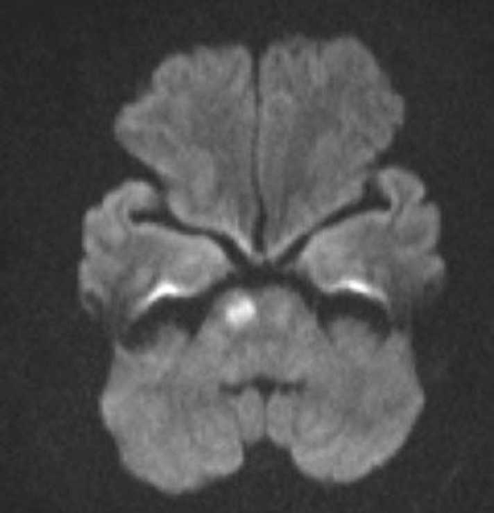 Hình ảnh Cộng hưởng từ sọ não (MRI) của người phụ nữ bị ong đốt: Với xung khuếch tán Diffusion cho kết quả nhồi máu cầu não phải (Ảnh: BVCC)
