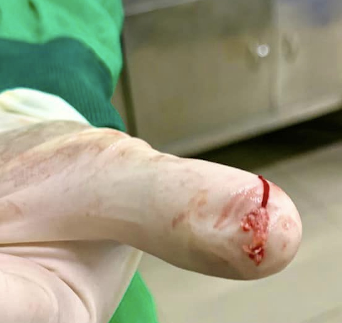 Sau khoảng 60 phút, các bác sĩ lấy ra được một mảng sùi kèm huyết khối và tái thông hoàn toàn động mạch não giữa cho bệnh nhân. (Ảnh: BVCC)