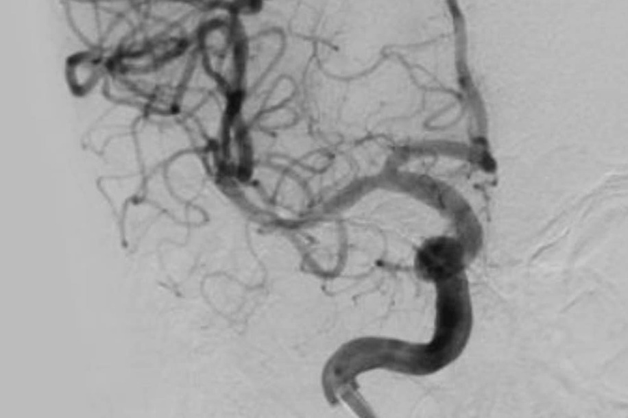 Nhồi máu não cấp trên bệnh nhân viêm nội tâm mạc nhiễm trùng