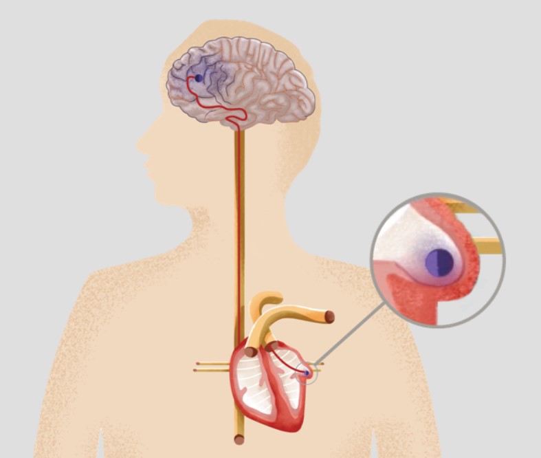 Rung tâm nhĩ không được điều trị có nguy cơ cao bị đột quỵ và suy tim.