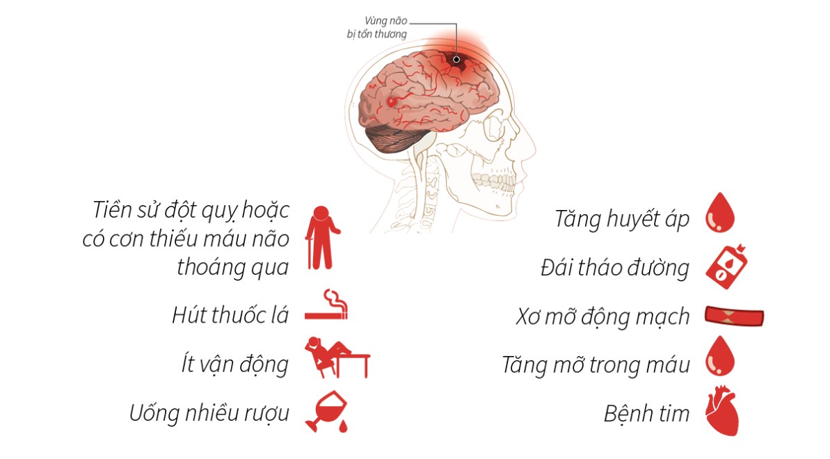 Một số bệnh và thói quen làm tăng nguy cơ đột quỵ