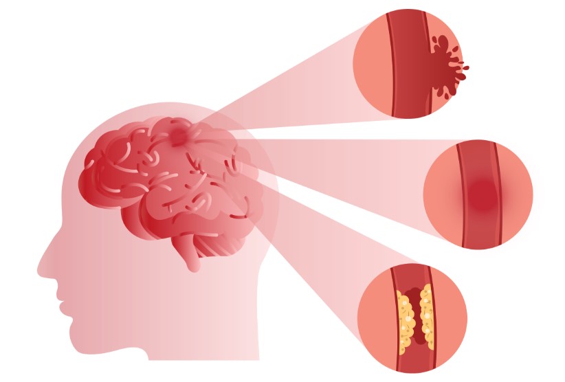 Đột quỵ xảy ra khi một cục máu đông hoặc bất kỳ chỗ vỡ nào làm tắc nghẽn mạch máu. 
