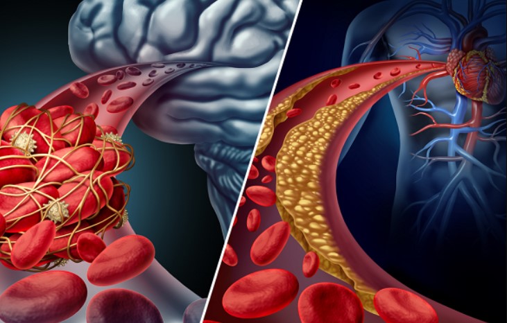 Tiểu đường là yếu tố nguy cơ bệnh tim và đột quỵ.
