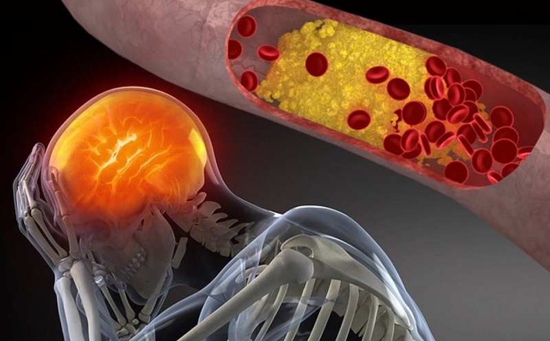 Cholestrol dư thừa sẽ gây ra hiện tượng tích tụ, tạo ra các mảng xơ vữa và khiến mạch máu tắc nghẽn, từ đó gây thiếu máu não dẫn đến đột quỵ.