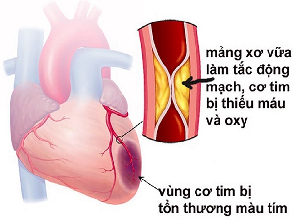 Bệnh mạch vành là gì và có bao nhiêu loại?