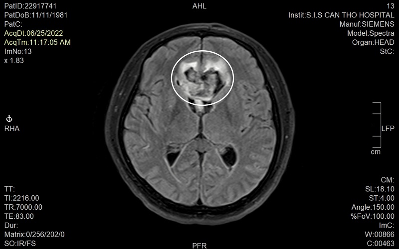 Cứu sống bệnh nhân 3 lần hôn mê vì xuất huyết não do vỡ túi phình