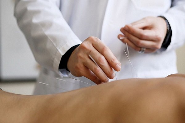 Có nên châm cứu sau đột quỵ?