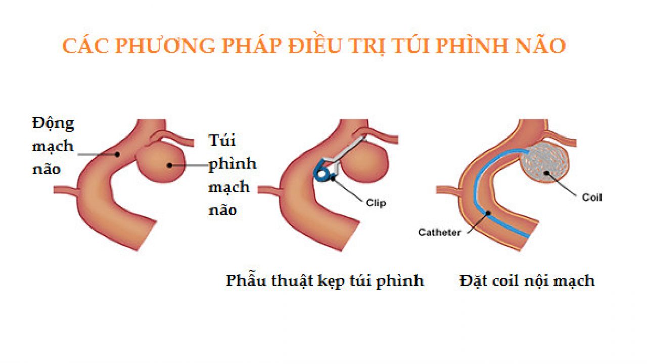 Cuộn nội mạch là gì và được thực hiện như thế nào?