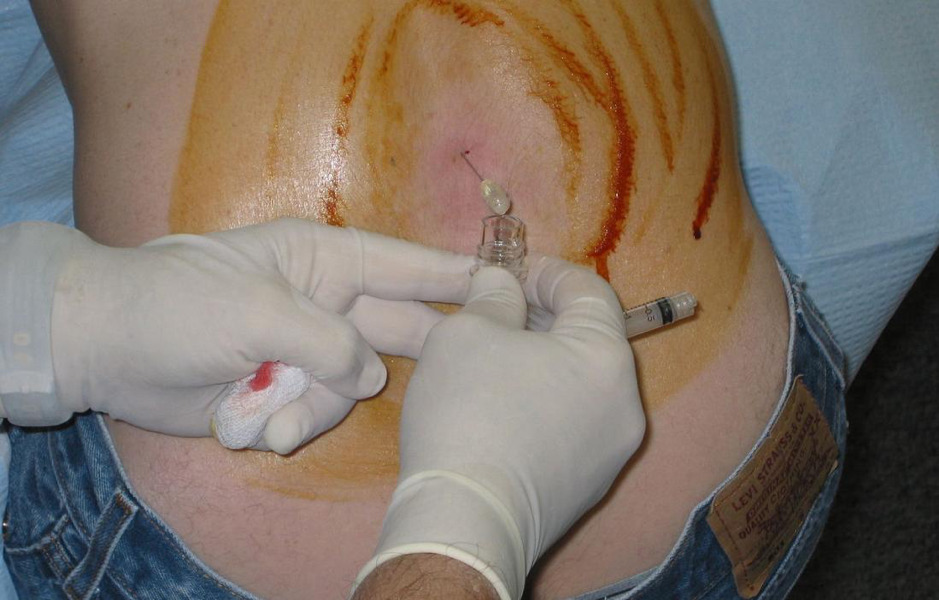 Chọc dò thắt lưng được sử dụng để thu thập các mẫu dịch não tủy.