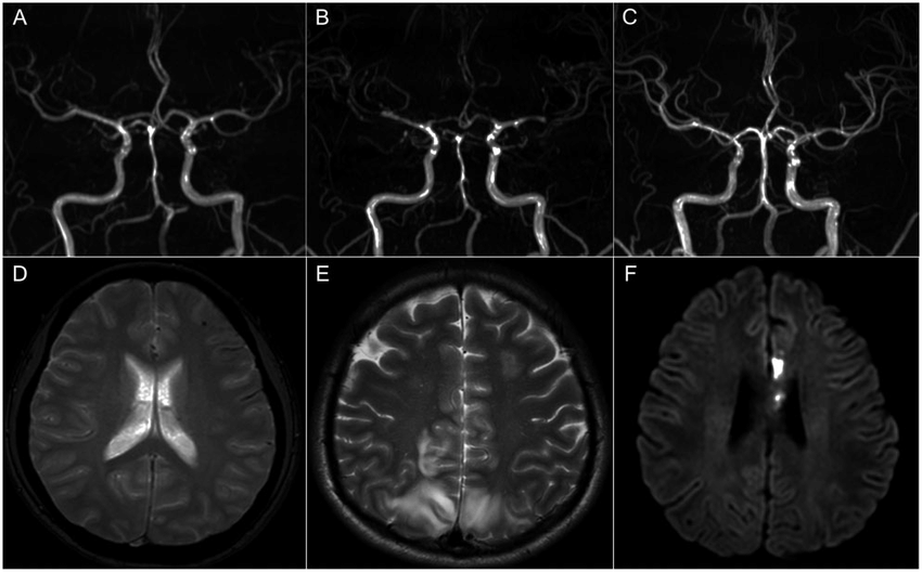 Hội chứng co mạch máu não đảo ngược là một tình trạng hiếm gặp xảy ra do sự co thắt đột ngột của các mạch cung cấp máu cho não.