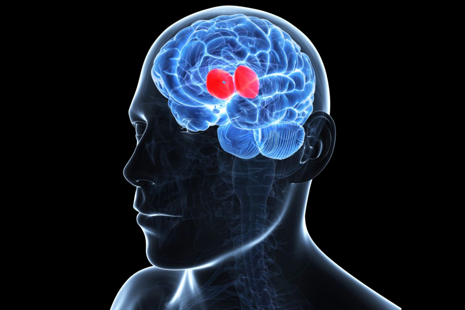 Đột quỵ xảy ra ở đồi thị hoặc hạch nền sẽ khiến một người gặp phải chứng run.