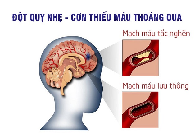 Đột quỵ nhỏ là dấu hiệu cảnh báo một cơn đột quỵ lớn có thể xảy ra ở tương lai