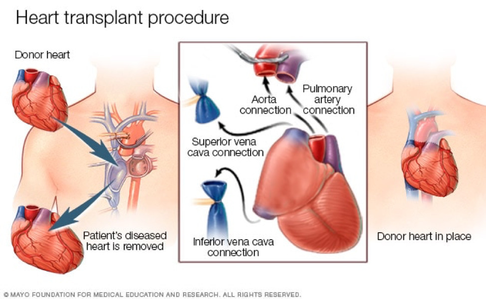 Phẫu thuật được thực hiện khi các phương pháp điều trị khác cho các vấn đề về tim không hiệu quả, dẫn đến suy tim.