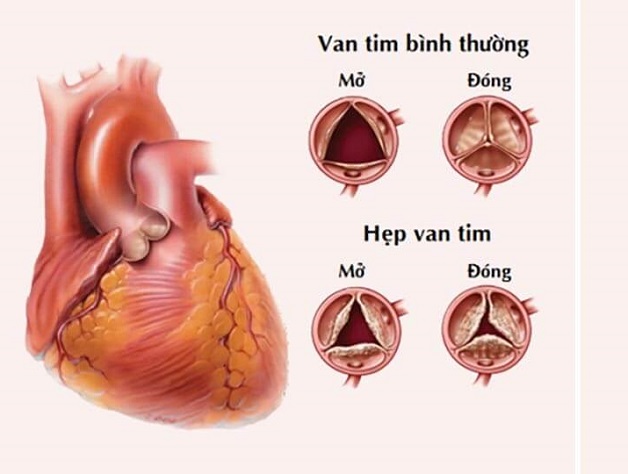 Hẹp van tim là tình trạng các lá van không thể mở ra hoàn toàn làm cản trở quá trình lưu thông máu qua van.
