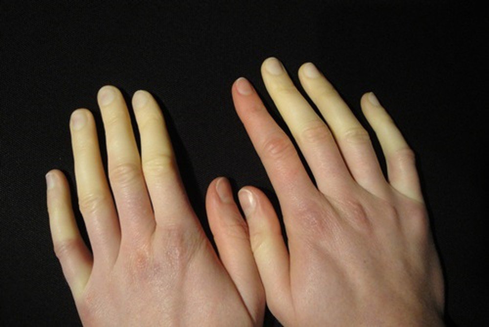 Hội chứng Raynaud thắt chặt các mạch máu ở bàn tay và bàn chân.