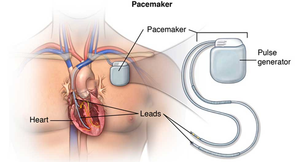 Người bệnh đang sử dụng máy tạo nhịp tim cần lưu ý những gì?