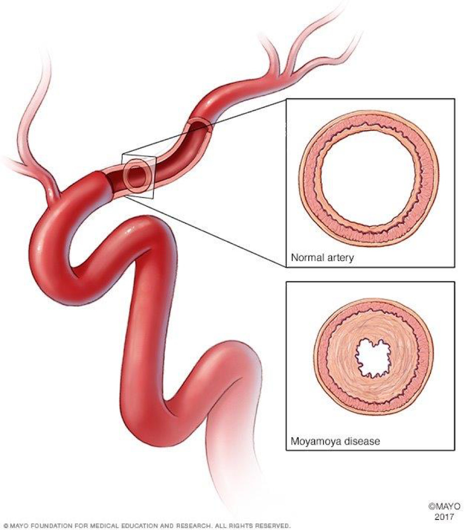 Bệnh Moyamoya – căn bệnh hiếm gặp gây đột quỵ ở trẻ em