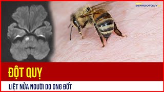 Hiếm gặp: Đột quỵ, liệt nửa người do ong đốt ở Phú Thọ
