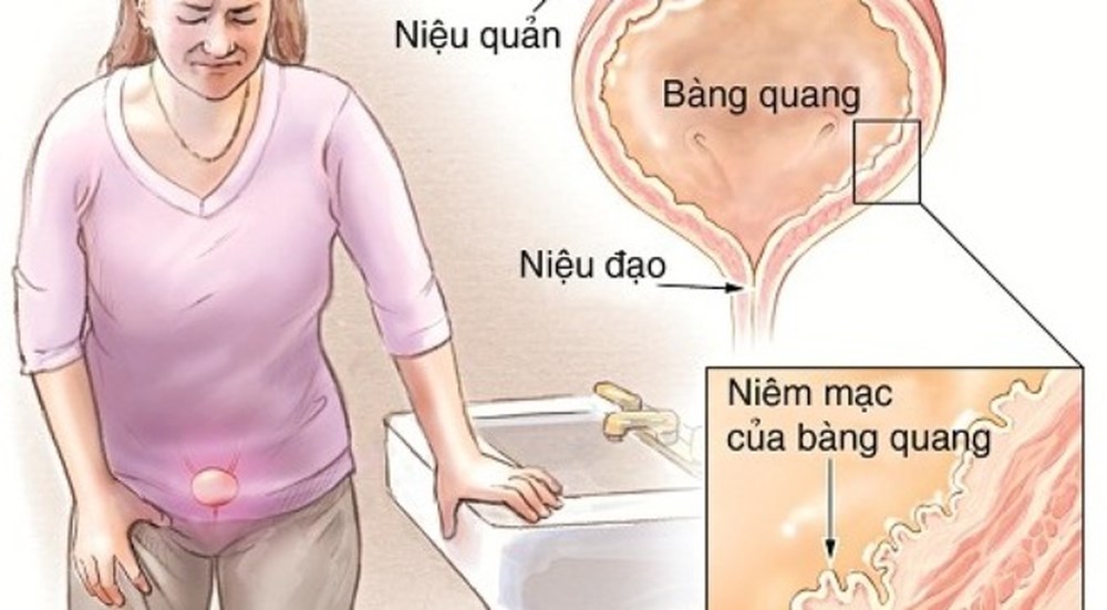 Nhiễm trùng bàng quang là một trong những tác dụng phụ thường gặp khi dùng thuốc.